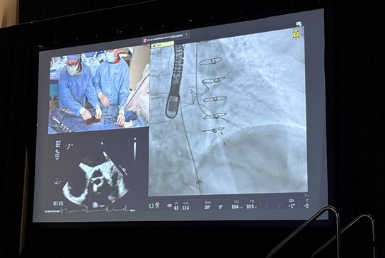 Live structural heart procedure displayed during a 2025 Northern California Structural Heart Summit presentation.